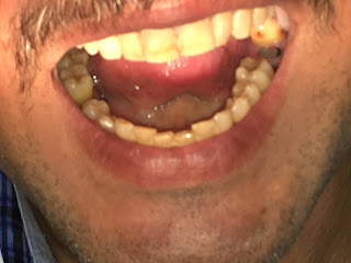 Middle-aged dental patient with minor tooth loss - dr adel zakhary